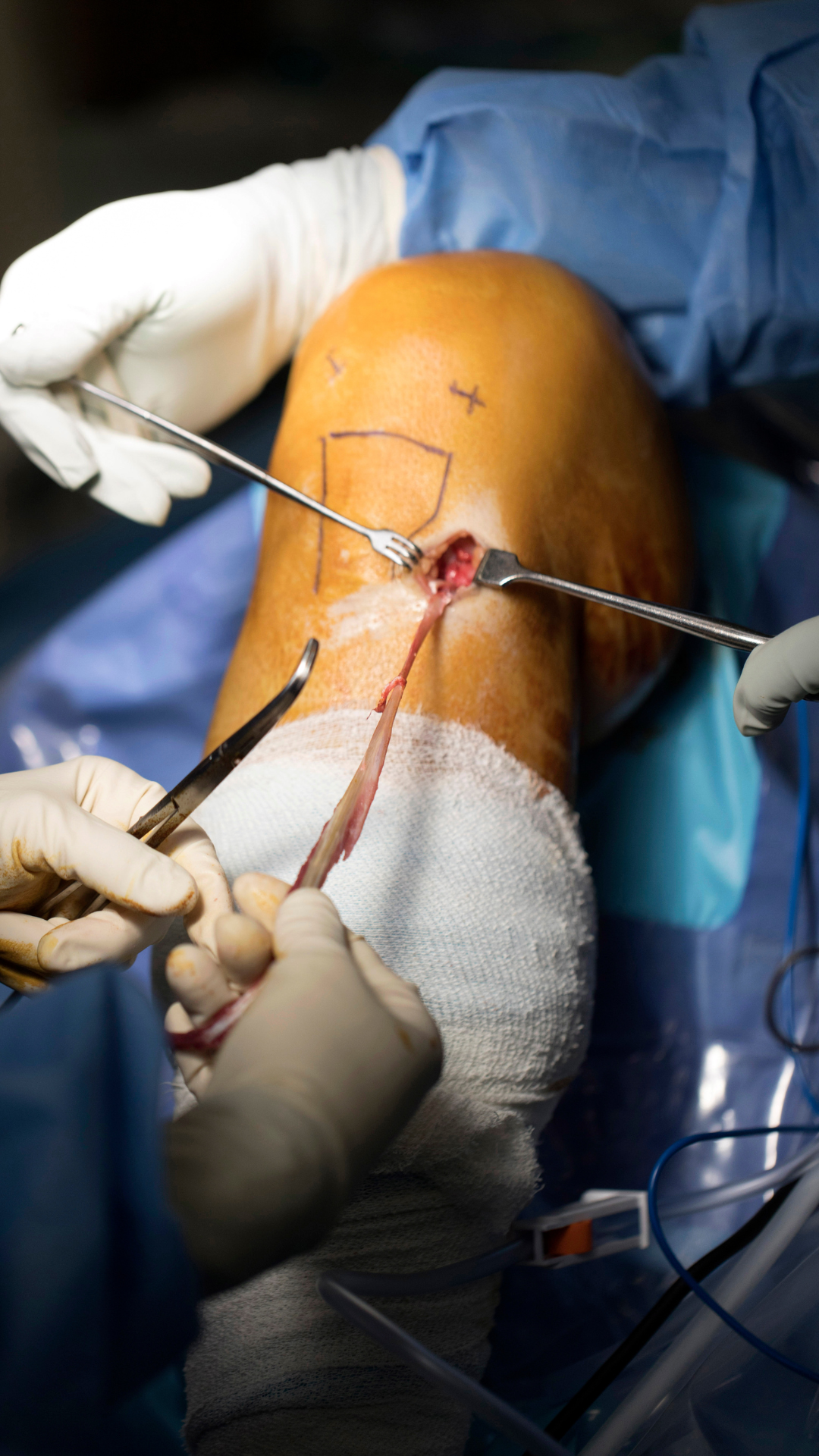 Post‑Operative Rehab: Your Guide to a Stronger Recovery